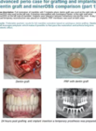 Advanced perio cas for grafting and implants - dentin graft and minerOSS comparison (part1)