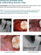 Saving the proximal tooth by augmenting alveolar ridge