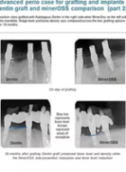 Advanced perio case for grafting and implants - dentin graft and minerOSS comparison (part 2)